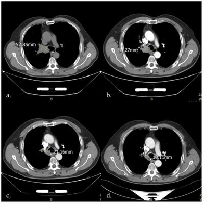 Case Report: Bronchial artery embolization and chemoradiotherapy for central squamous cell lung carcinoma with rapid regression